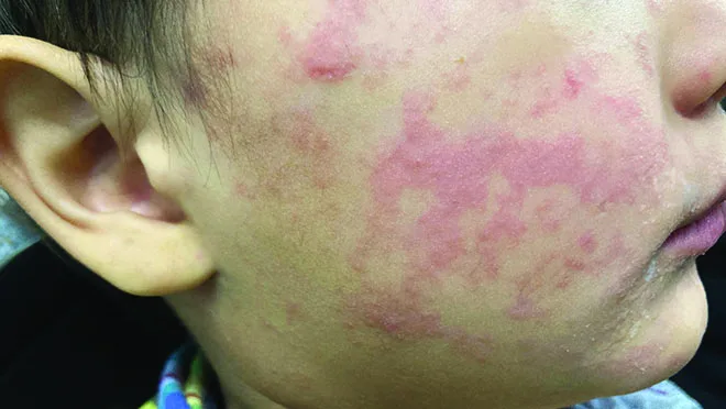 Three measles cases in Delta — first since 1989